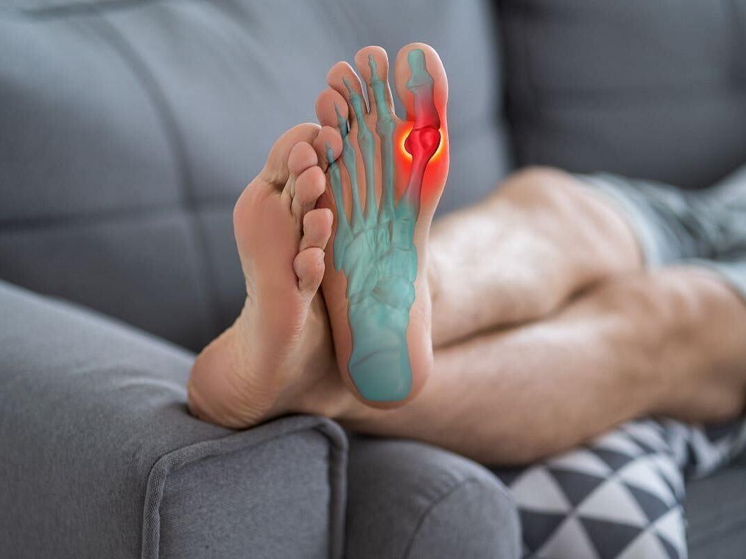 Gene Test Can Predict Risk For Gout Medicine Side Effects